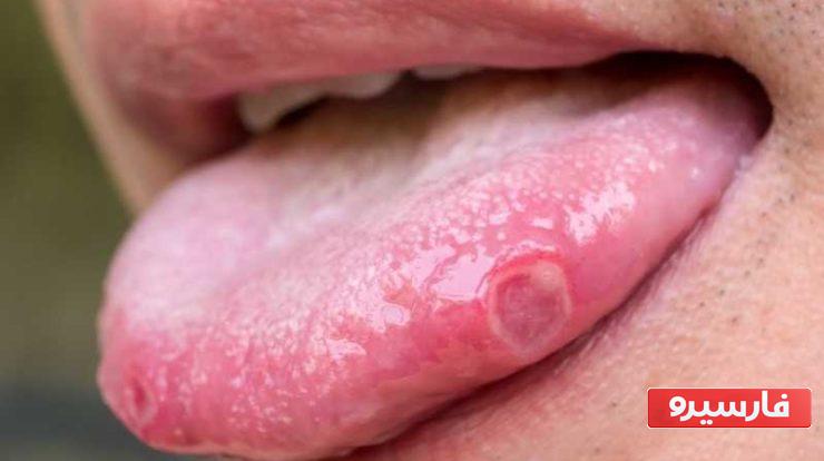 درمان گیاهی زخم دهان و زبان 