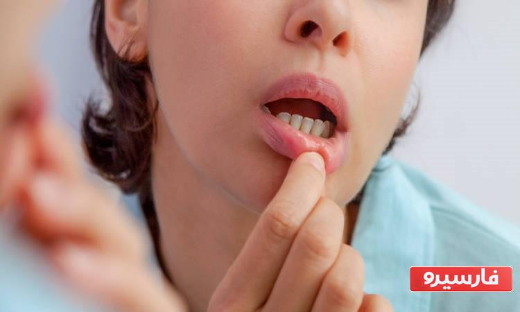درمان آفت دهان در خانه 
