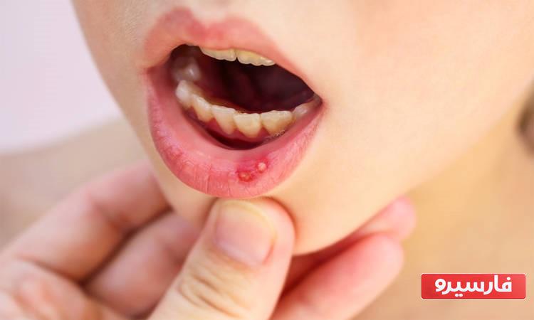 درمان خانگی زخم دهان و زبان 