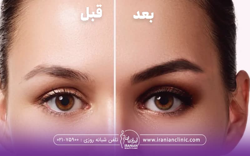 عکس قبل و بعد دختری که ابروهای خود را کاشت کرده است