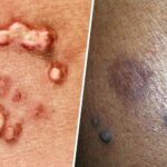 موثرترین روش‌های پزشکی برای درمان زگیل تناسلی زنان