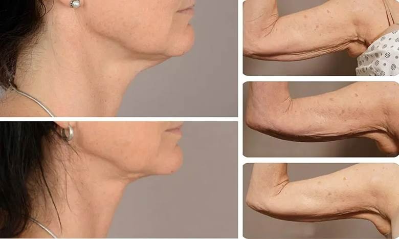 رنوویون چیست؟