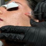 دختری که عینک به چشم دارد و پزشک به صورت او پروفایلو تزریق می کند