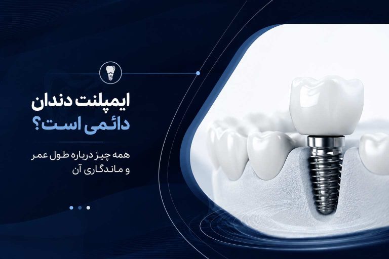 ایمپلنت دندان دائمی است؟ همه چیز درباره طول عمر و ماندگاری آن
