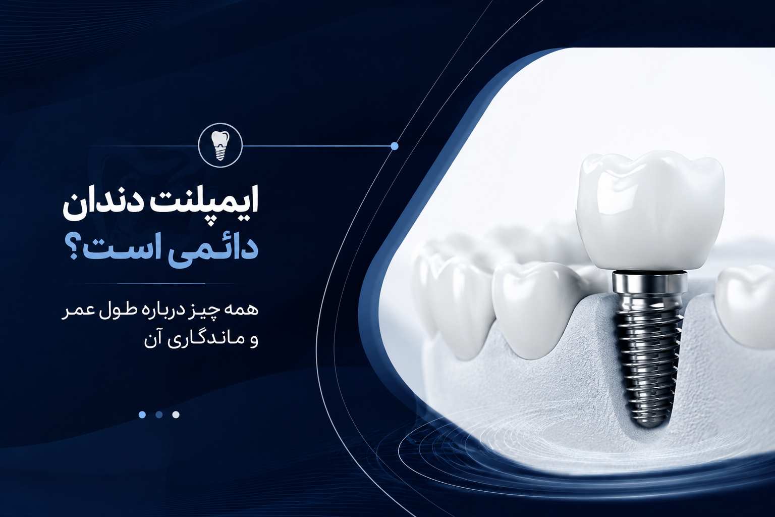 ایمپلنت دندان دائمی است؟ همه چیز درباره طول عمر و ماندگاری آن