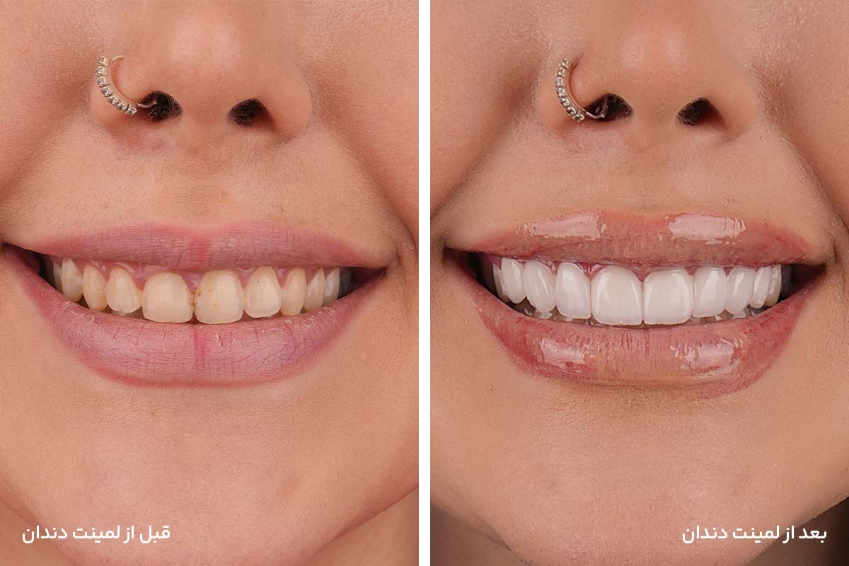 نتیجه لمینت در مشهد